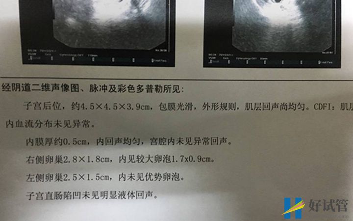 卵泡不破的原因已找到,卵泡闭锁、内分泌失调是主因(图2) 卵泡破裂报告单