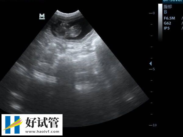 香港大学深圳医院做试管婴儿的价格公开,单次不超这个数!(图2) 香港大学深圳医院做试管多少钱一次