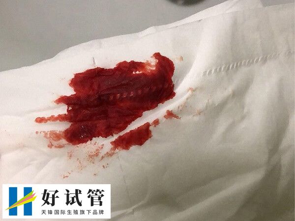 试管移植后怎么判断宫外孕(图1) 试管移植后出血多可能是宫外孕